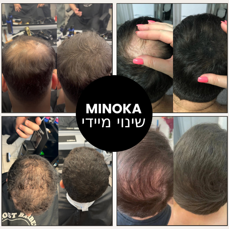 אבקת Minoka – מספר 1 בהסתרת קרחות
